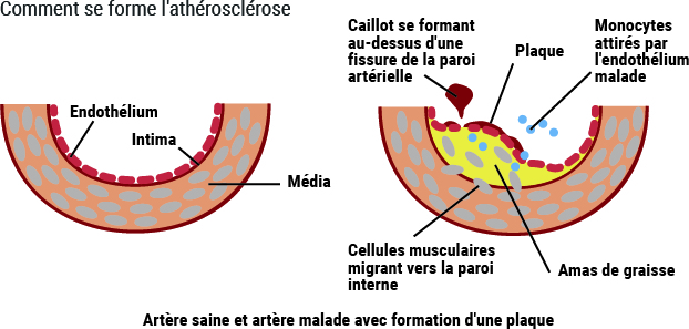 comment-se-forme-lastherosclerose