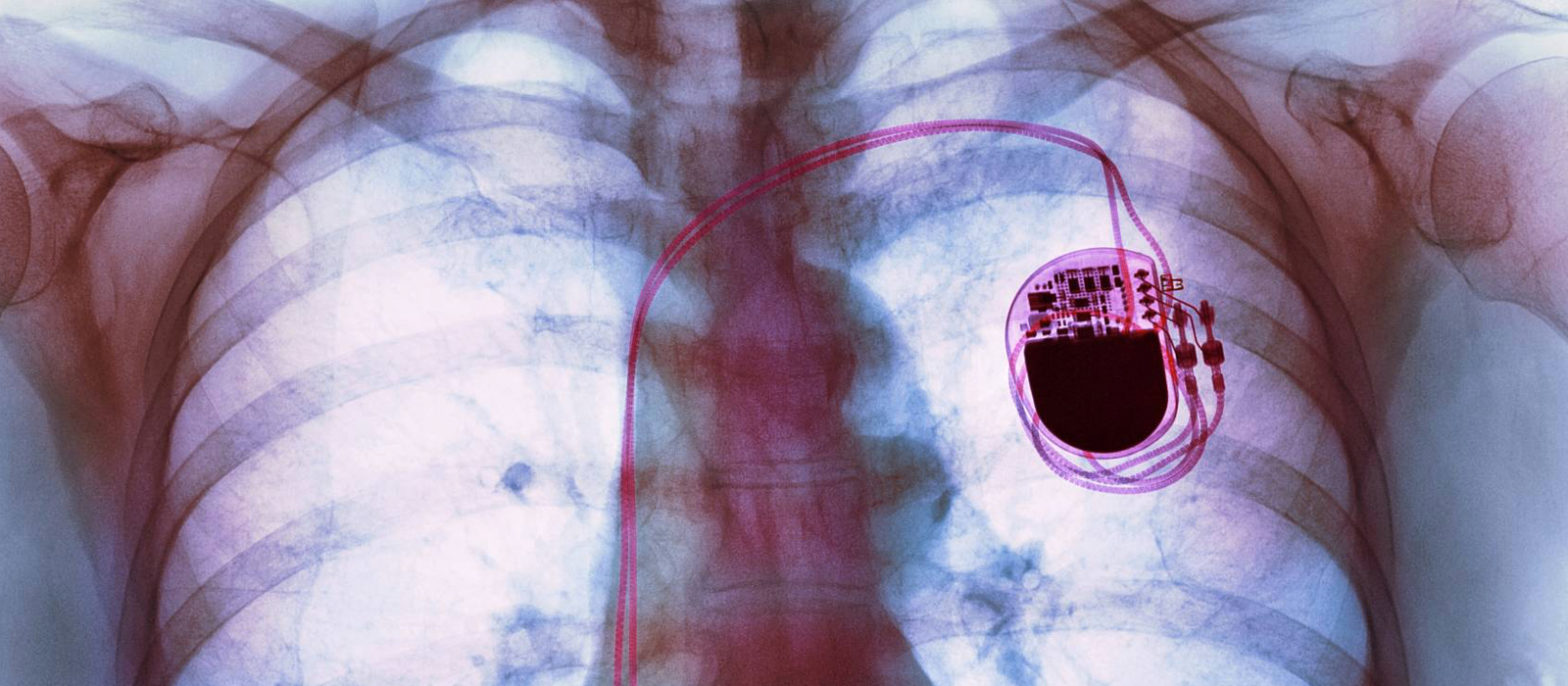 Peut-on faire du sport avec un pacemaker ?