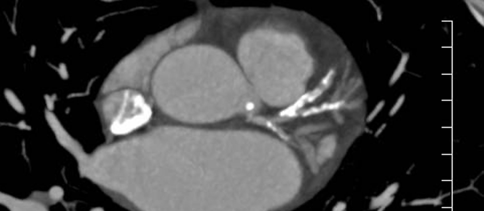 La calcification coronaire au cœur de la prévention