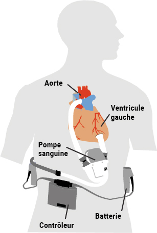 L'insuffisance cardiaque, les traitements - FFC